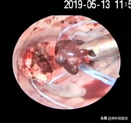 微创手术后血肿是什么,颅内血肿微创清除术多少钱