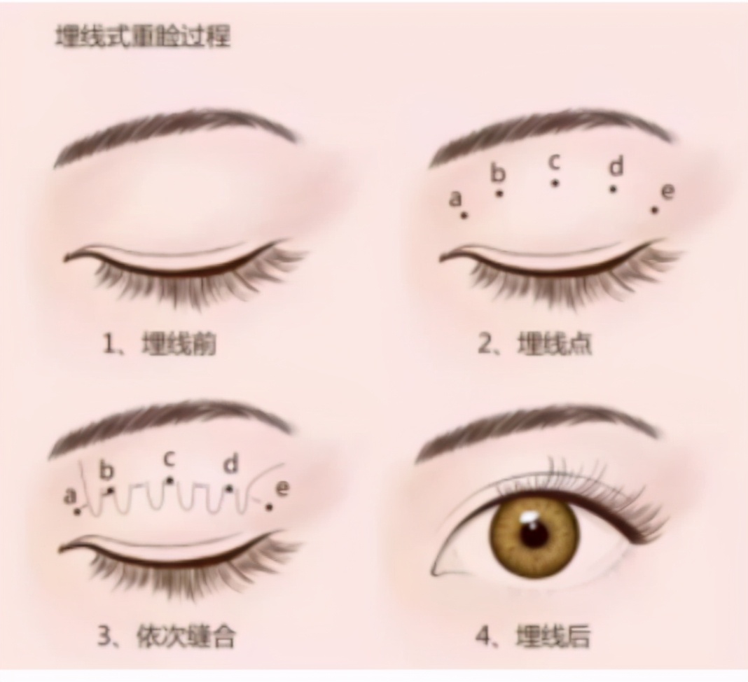 你应该选择哪种双眼皮手术方法,双眼皮手术淡化疤痕的6个小妙招