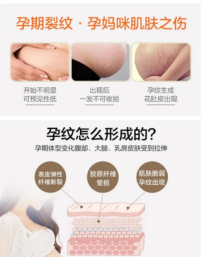 腿上有生长纹是还会长吗,怀孕四个多月大腿上长妊娠纹