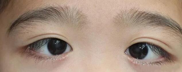 小孩近视导致斜视能不能恢复,小孩斜视又不会说话