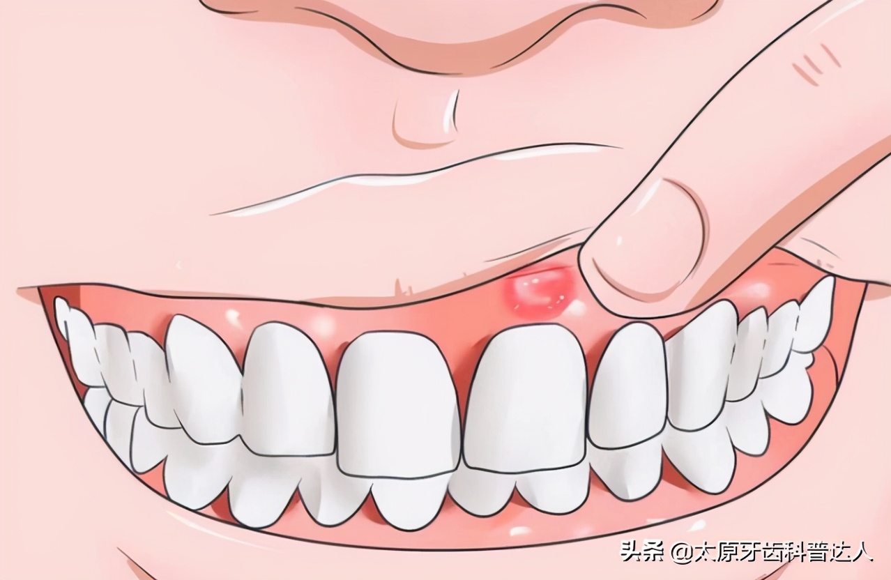 牙龈肿痛发炎是哪个脏腑引起的,十大常见牙龈疾病