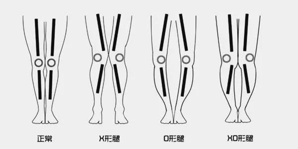 练就笔直大长腿，OX腿型如何应对？！｜运动康复003课