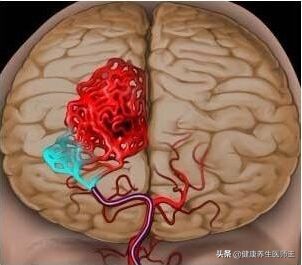 脑出血生命之缘,生命缘脑出血纪录片