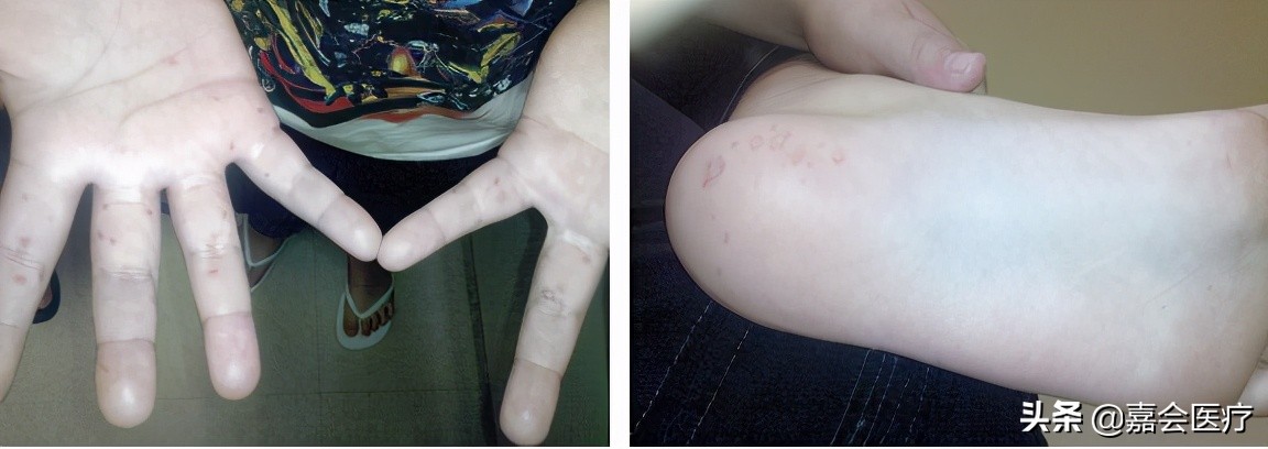 手足口病诊疗指南及解读,手足口病知识普及