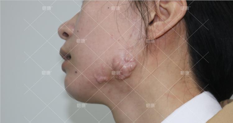 北京疤康对疤痕疙瘩能看好吗,疤康疤痕疙瘩恢复图片