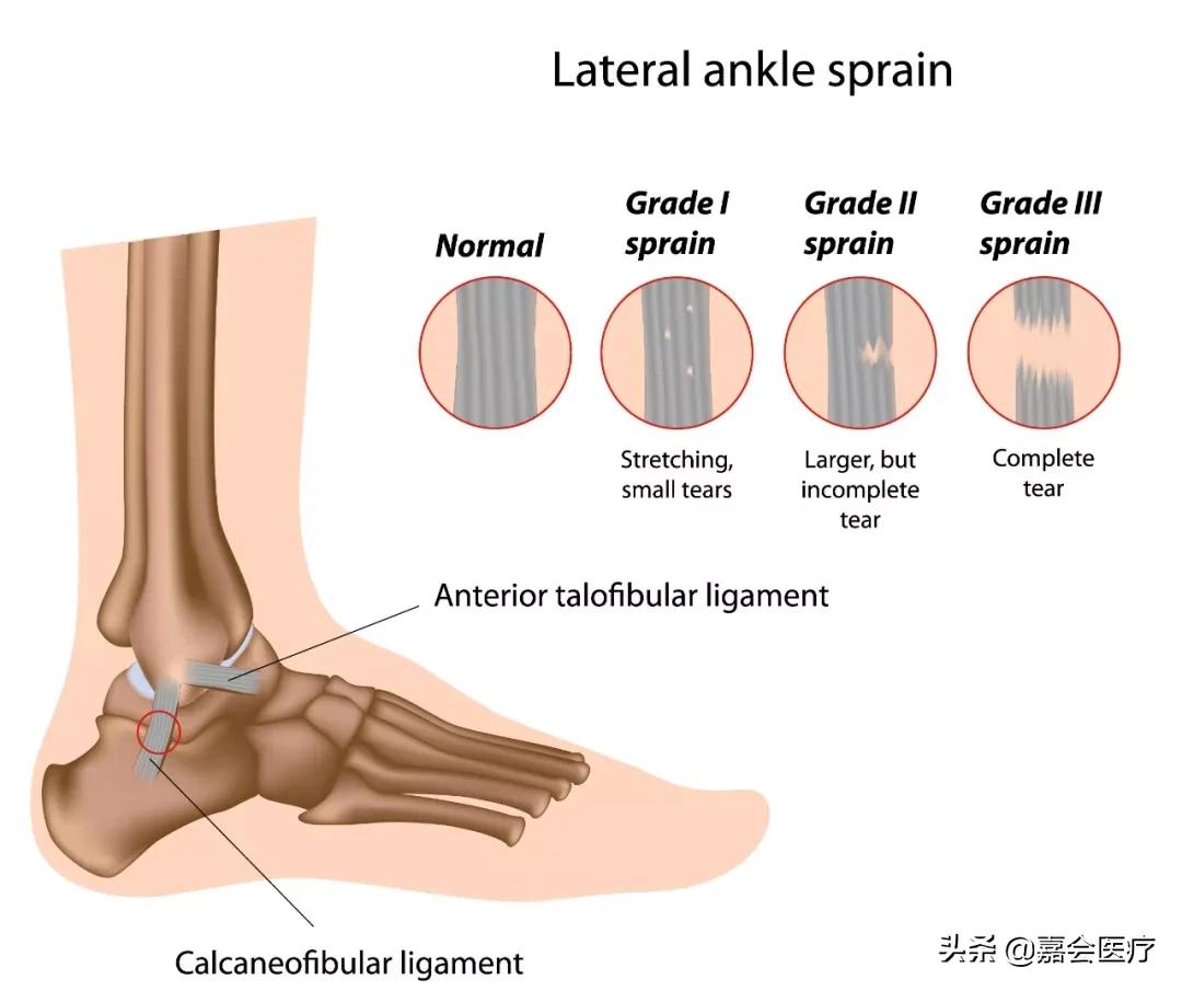 脚踝损伤怎么快速消肿,脚踝损伤怎样有利于恢复