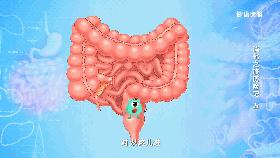 肠道安全检查!遇上肠息肉、结直肠癌……怎么办?