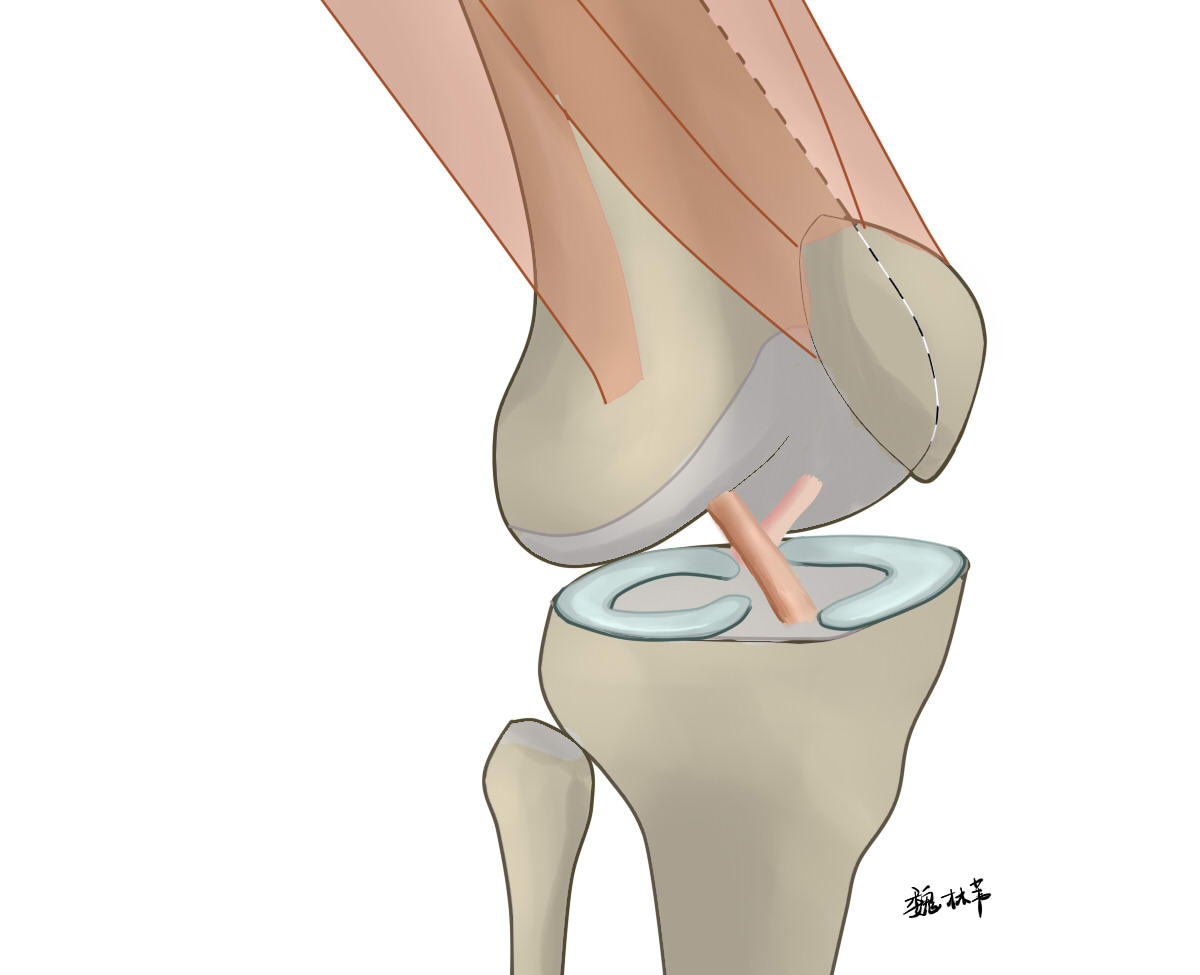 半月板缝合后面磁共振还显示撕裂,半月板缝合后为啥复查还是撕裂