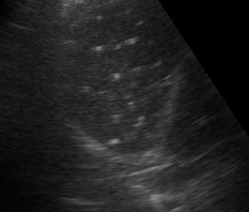 b超显示肝内胆管结石或钙化灶,b超发现肝部有黑点