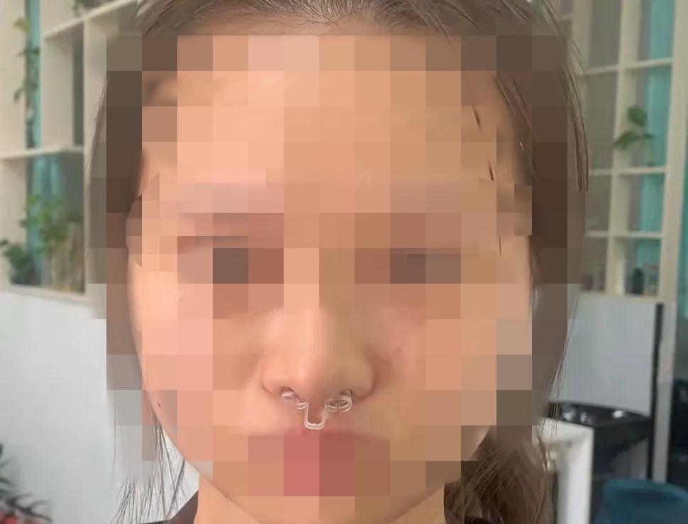 “你用手掰回来啊！”深圳女子整容歪鼻，医生竟让她自行掰正