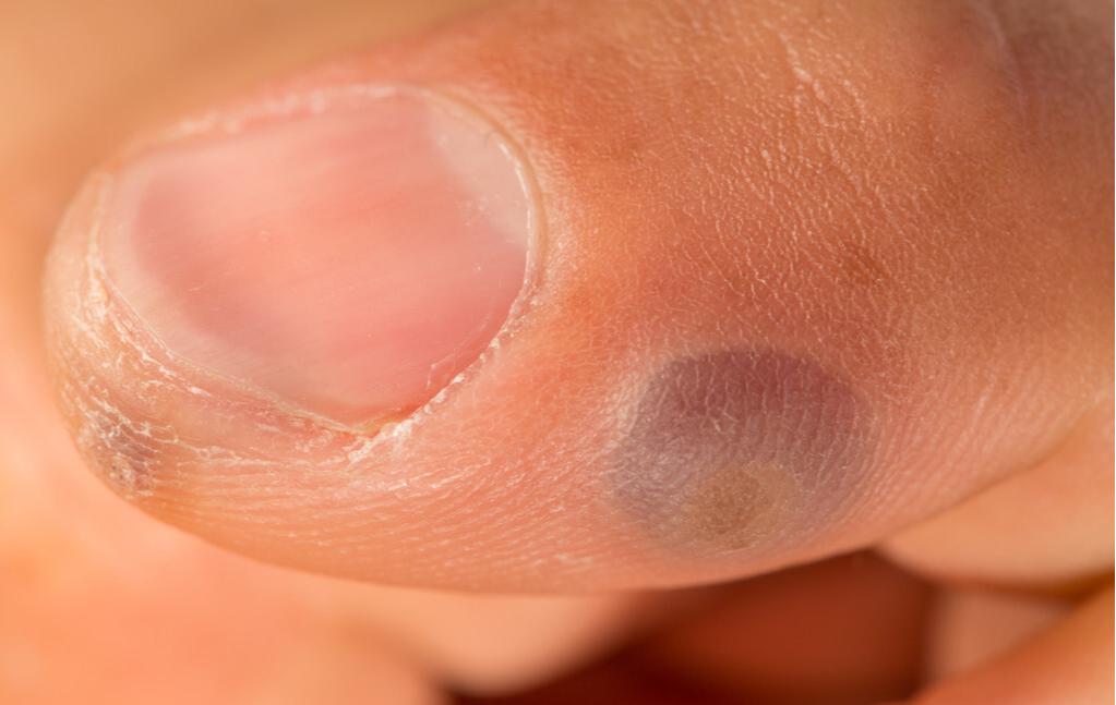 目前填充法令纹最好的办法,永久填充法令纹的方法