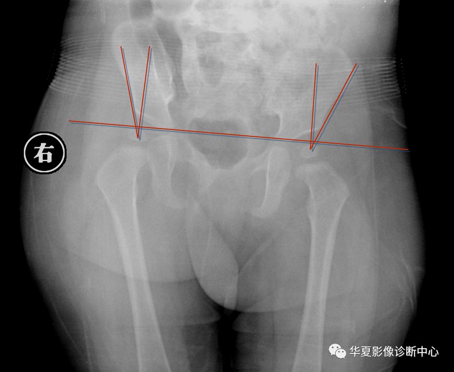 先天性髋关节脱位截骨术全过程,先天性髋关节脱位可以考驾驶证吗