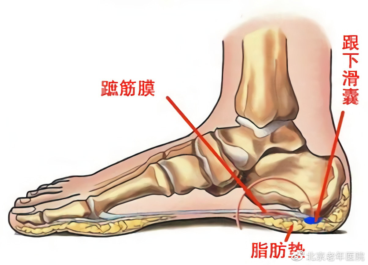 【为了您的健康，我们的专家有话说】足跟痛的黑锅不能全让骨刺来背，揪出幕后的真正元凶