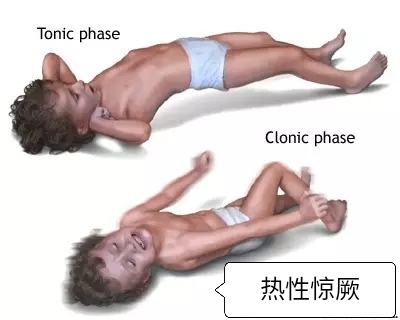 家庭高热惊厥抽搐的紧急处理方法,小孩子发热惊厥抽搐有得治的吗