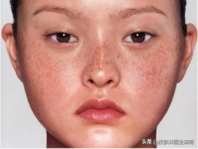 富贵痣点掉了,有福的痣点掉