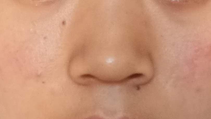 关于黑头的问题和解决方法,去黑头的误区许多人都中招了