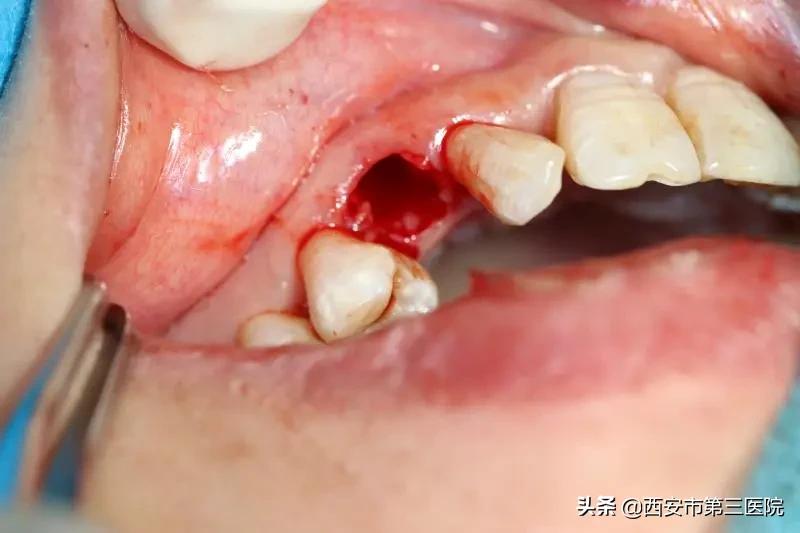 关注口腔健康的策划案例,关注口腔健康数字化种植牙