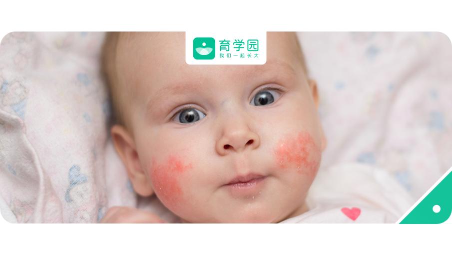 崔玉涛谈宝宝过敏怎么办,过敏会导致孩子矮小吗崔玉涛