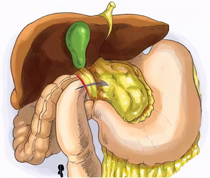 腹膜结核去哪里治疗,腹膜结核引起大量积水严重吗