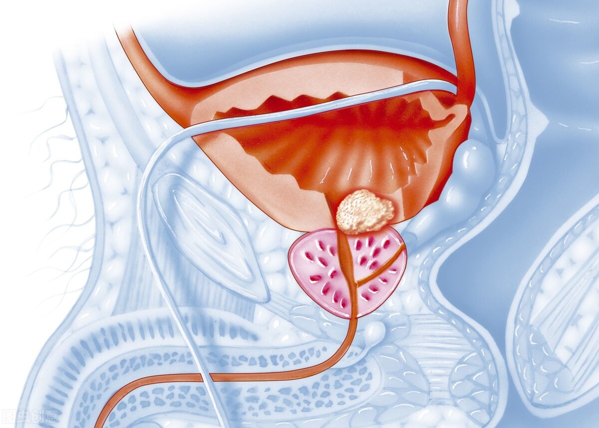 膀胱肿瘤的护理方法,膀胱肿瘤电切后膀胱冲洗注意事项