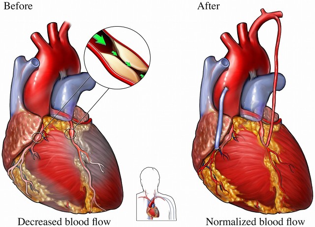 心脏支架为什么容易再次堵塞,心血管堵塞支架手术要拆吗