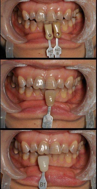 美牙冠改善龅牙,美牙冠可以修复缝隙吗