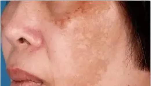 想要祛斑，先了解斑！有些斑连医美都治不好，你知道吗？