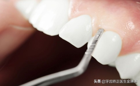 牙齿缝里有牙结石怎么才弄得掉,牙结石去临泉哪里洗牙好