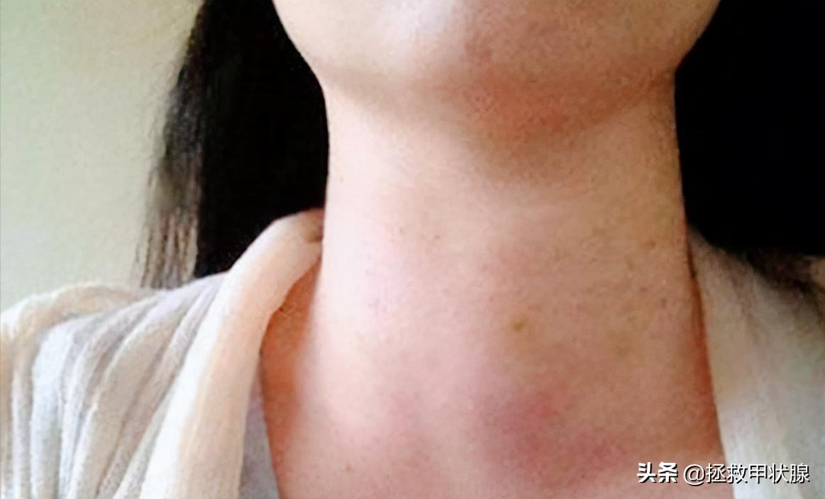 甲状腺结节可以吃软坚散结药吗,查出结节不用怕中医帮你化解