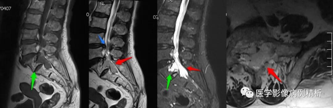 海绵状血管瘤在mri中的影像表现,骶骨处影像显示有血管瘤
