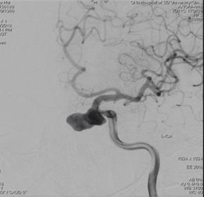 颈内动脉c3段动脉瘤是什么症状,右颈内动脉c3段动脉瘤是什么意思
