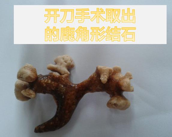 疯狂的石头碎石,疯狂的石头包世宏结石