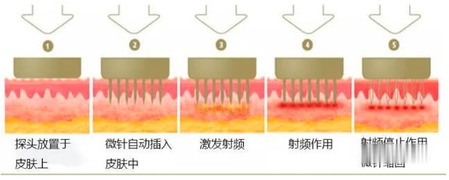 脸颊毛孔变粗有办法解救吗,脸颊器质性毛孔粗大