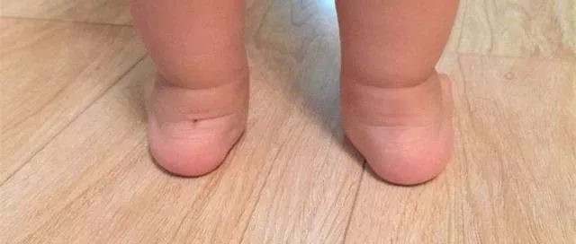 足部健康知识,足外翻的治疗及护理