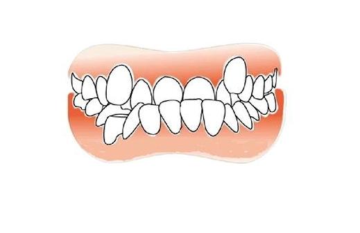 牙齿不齐磨平咋办,牙齿不齐不能矫正怎么办