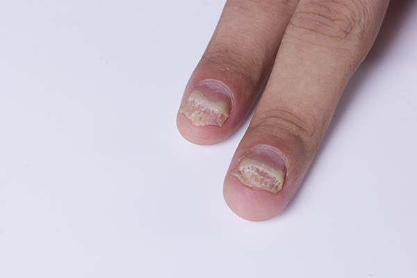 得了灰指甲必须吃口服药么,拔指甲能去除灰指甲吗