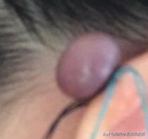 耳朵上的瘢痕疙瘩可以用线勒掉吗,耳朵疤痕疙瘩手术多少钱