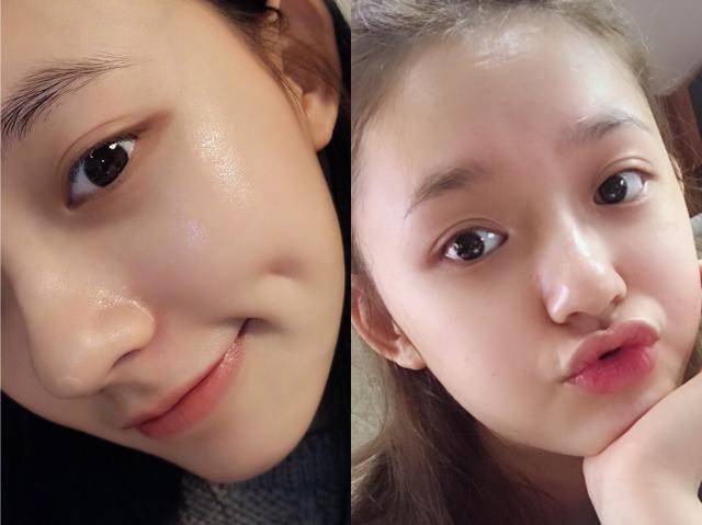 光了嫩肤后皮肤会变光滑吗,皮肤黑光子嫩肤10天变化图片