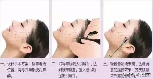 500元的微针和5000元的微针,线雕的优点和缺点