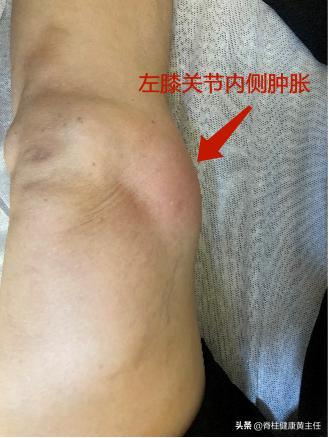 因摔倒致膝盖疼痛肿胀怎么治疗,摔倒后膝盖弯曲时疼痛且有肿胀感