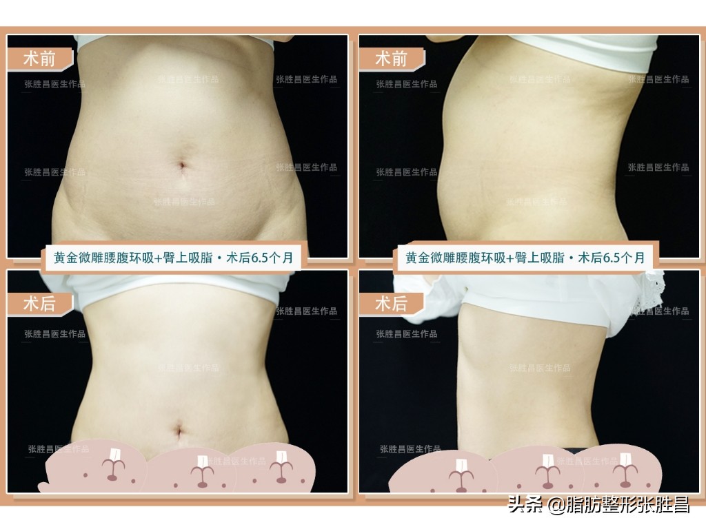 真的有边吸脂边提升的吸脂方法吗,吸脂手术的四大误区
