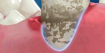 刷牙时一个小窍门彻底告别黄臭牙,刷牙的时候放点小苏打牙会变白吗