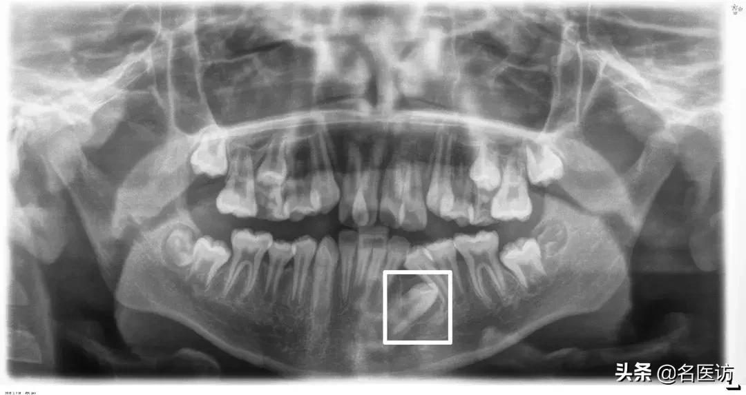 矫正科普|美人在骨不在皮，从神秘的牙片看牙齿和侧貌颜值