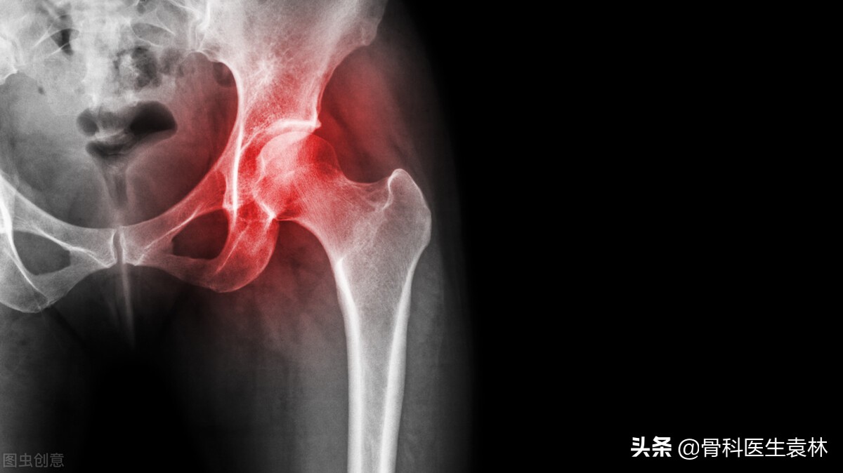 股骨头早期坏死怎样治疗,早期股骨头坏死的最佳治疗法