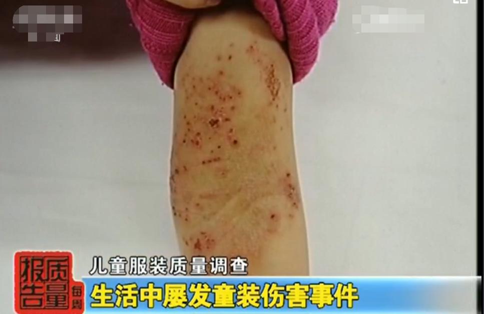 小孩穿衣服千万得注意,儿童穿不合格的衣服