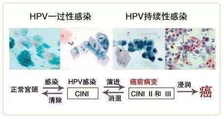 持续感染hpv18几年阳性tct正常,tct正常hpv18阳性到底用不用治