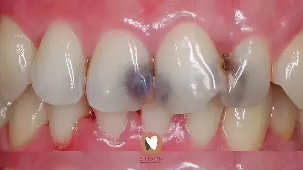 三甲医院全瓷牙保质期,全瓷牙有缝隙保质期是多久