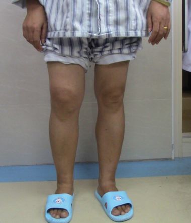 膝关节外侧肿胀且反复发作,神秘原因导致单侧膝关节反复肿胀