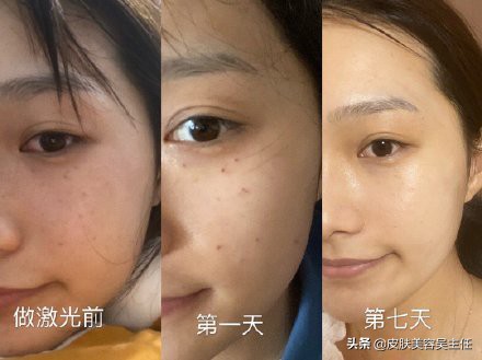 激光可以祛斑祛痣吗,激光可以彻底祛斑吗多少钱