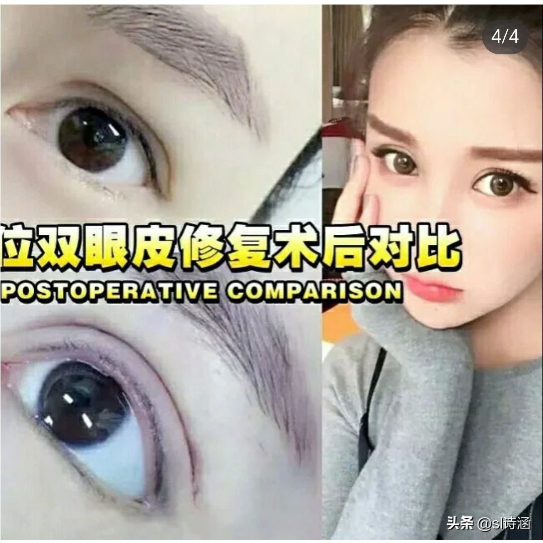 做完双眼皮后的注意事项,做完双眼皮过后应该注意些什么